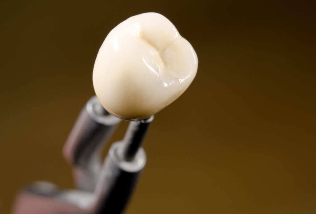 dental implant